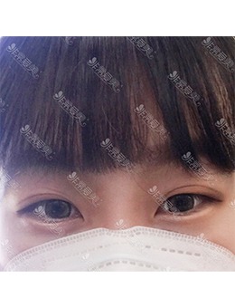 韩国YELLOW整形外科埋线双眼皮+上睑脂肪去除，眼部神态改变非常大！