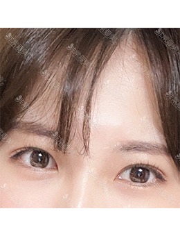 韩国YELLOW整形外科埋线双眼皮+上眼角提肌，灵动美眼轻松收获！_术后