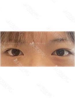 韩国双眼皮修复手术选现代美学整形就没错，轻松get清纯无辜眼！_术前