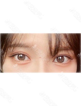 韩国双眼皮修复手术选现代美学整形就没错，轻松get清纯无辜眼！_术后