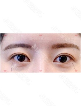韩国外眼角修复和眼睑下至修复之后气质变化太明显！_术前