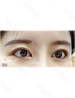 韩国外眼角修复和眼睑下至修复之后气质变化太明显！