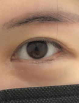 韩国可来熙双眼皮修复案例对比图展示,一双眼改变一张脸是真的_术前