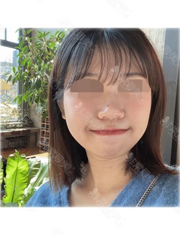 韩国鼻综合好的医院中KOKO整形医院做鼻子非常厉害！_术前