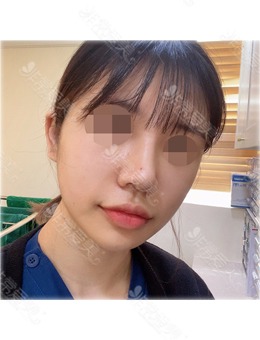 韩国鼻综合好的医院中KOKO整形医院做鼻子非常厉害！_术后
