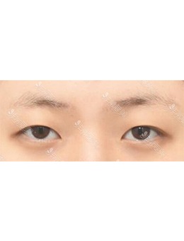 韩国ICON整形医院埋线双眼皮+眼肌矫正+去除脂肪，前后变化惊人！_术前