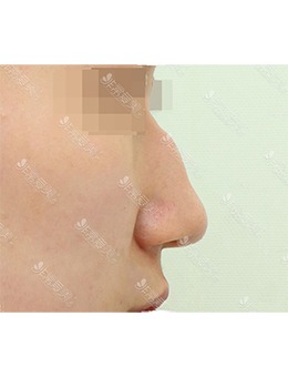 -韩国温度整形外科驼峰鼻矫正，精致立体的鼻子这不就来了！