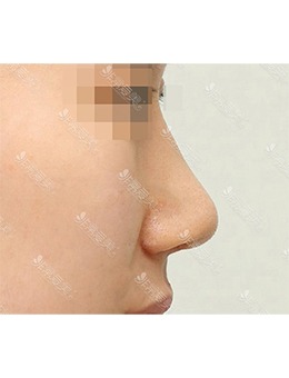 韩国温度整形外科驼峰鼻矫正，精致立体的鼻子这不就来了！