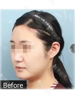 面部吸脂后特别后悔?我在韩国Snow整形做面吸后变化很大,也不后悔！