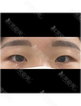韩国做双眼皮去哪家?推荐你看看韩国ICON整形医院眼睛整形对比照！_术前