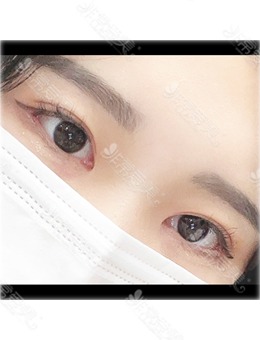 韩国做双眼皮去哪家?推荐你看看韩国ICON整形医院眼睛整形对比照！_术后