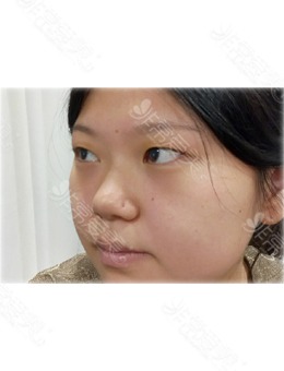 在韩国爱乐整形做完眼鼻整形手术之后，从土妹逆袭成气质女神！