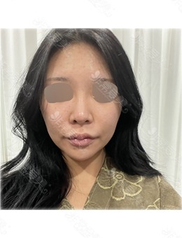 韩国鼻修复医院推荐爱乐整形外科,鼻修复真人案例绝美!