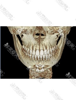 -韩国医院下颌角手术前后ct照曝光，术后骨骼线条又美又流畅！