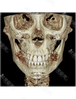 韩国1%整形医院做颧骨颧弓整形和下巴截骨手术CT图公开！
