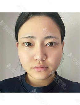 韩国ARC整形外科眼综合+鼻综合+轮廓三件套前后照片公开！_术前