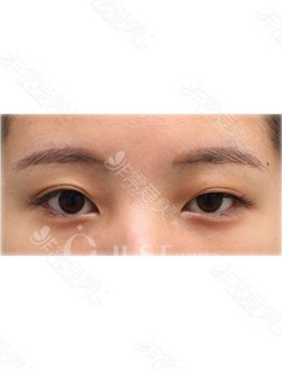 韩国做双眼皮好的医院有Just整形外科，双眼皮+提肌变化超大!_术前