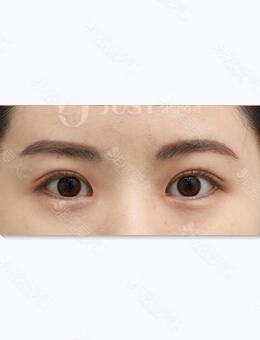 分享一组韩国JUST整形外科医院双眼皮加开眼角图片_术后