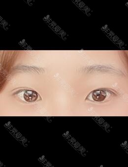 埋线双眼皮能做第二次，韩国icon整形二次埋线双眼皮图片分享_术前
