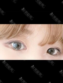 埋线双眼皮能做第二次，韩国icon整形二次埋线双眼皮图片分享_术后