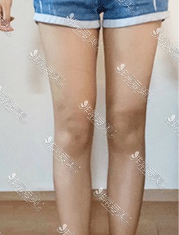 韩国宝士丽大腿膝盖吸脂术后变化，从此O型腿变美腿！