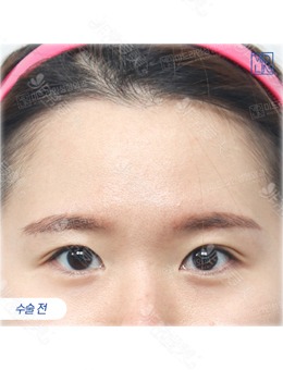 -韩国MIDLINE整形医院做的额头提升手术,额头缩小了,眼睛有神了！