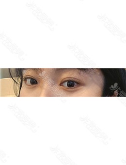 韩国欧艾尔ONAIR整形外科做自然粘连双眼皮太厉害了,这个变化真是爱了！