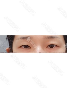 分享我在韩国欧艾尔ONAIR整形外科做双眼皮手术的经历！_术前