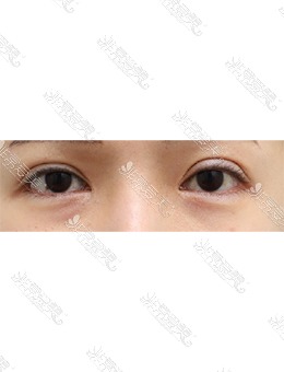 韩国JUST整形外科上眼皮脂肪移植+提肌，术后呈现灵动大眼！