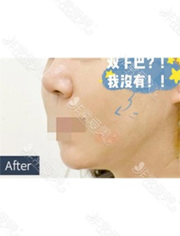 韩国面吸好的医院中宝士丽整形做面部吸脂的效果也太好了吧！