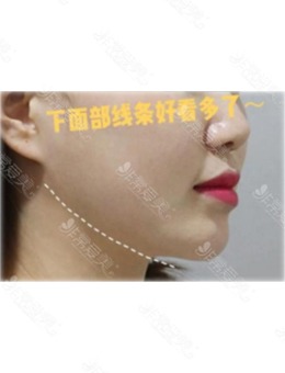 -韩国面部吸脂好的医院推荐宝士丽整形，术后小V脸超赞！