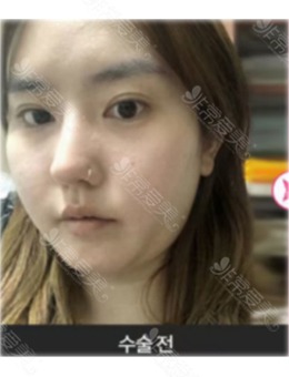 -韩国面吸好的医生做面部吸脂手术超厉害,附面吸前后对比!