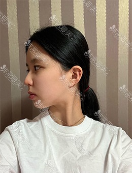 韩国WAVE整形医院鼻炎+鼻中隔屈曲症手术，美观度高了几个度！