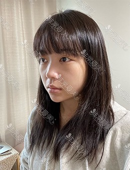 韩国WAVE整形医院鼻整形+鼻功能手术，鼻型美观且鼻功能恢复正常！_术前