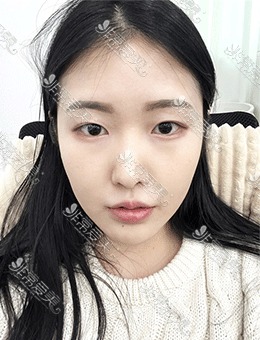 在韩国WAVE医院做了歪鼻矫正手术，从此跟鼻炎弯曲鼻说拜拜！