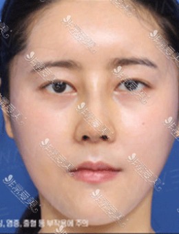 鼻孔朝天矫正前后照片，韩国WAVE整形的审美也太好了叭！
