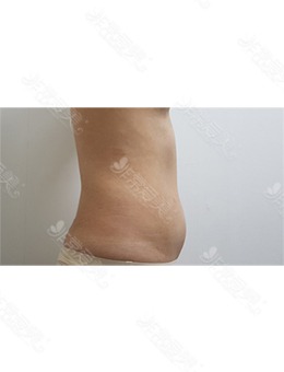 -韩国腰腹吸脂手术推荐LINE&VIEW整形外科,附腹部吸脂对比照!