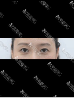分享韩国梦美整形做眉毛提拉和填充手术效果图！_术后