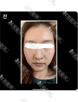 韩国梦美整形面部填充+玻尿酸+G提拉手术真实经历分享！_术前