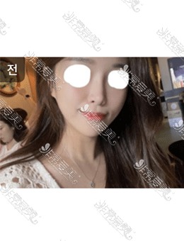 韩国梦美整形的面部填充术太棒了，轻松消除八字纹！