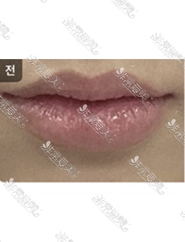 韩国梦美整形医院嘴唇填充手术真实案例！