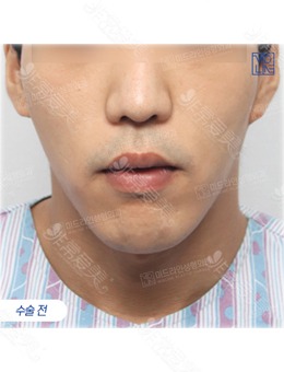 -韩国MIDLINE医院做的男士轮廓整形手术和下巴手术,变化很惊人！