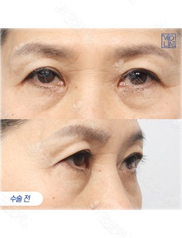 韩国眼底脂肪重置手术推荐MIDLINE整形医院,术后年轻好几岁!_术前