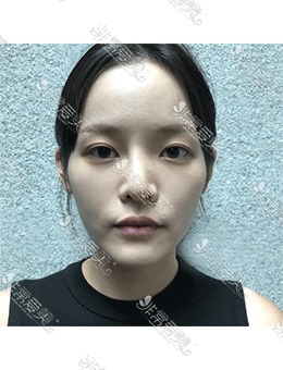 韩国脸本脸骨整形真人经历分享，术前到术后一年多的变化！_术前
