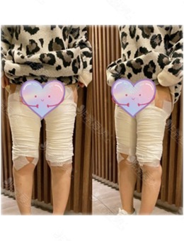 韩国宝士丽整形臀线吸脂打造的细长直大腿超好看！
