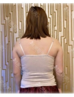 韩国背部抽脂手术推荐宝士丽整形,分享背部吸脂恢复前后对比照!