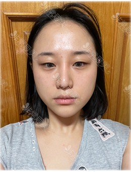 韩国面部轮廓医院推荐拉菲安整形,做轮廓三件套手术很厉害!