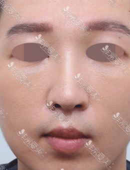 -韩国歪鼻整形比较好的医院星整形外科矫正前后图片！