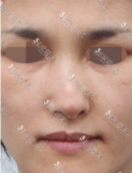 韩国星整形歪鼻修复案例图，网友评价是鼻修复靠谱医院！_术前