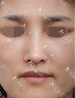 韩国星整形歪鼻修复案例图，网友评价是鼻修复靠谱医院！_术后
